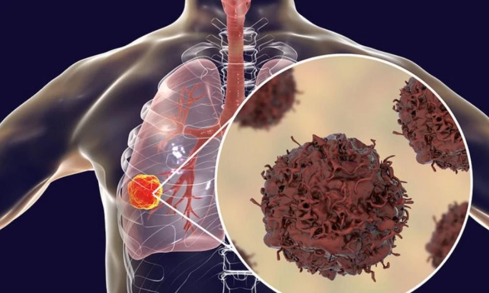 Καρκίνος του πνεύμονα: Τρίτη αιτία θανάτου στην Ελλάδα